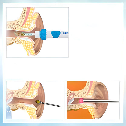 Aspirator Electric Hipoalergenic pentru Urechi, Rotativ 360, Sigur pentru Timpan (2 Capete Moi)